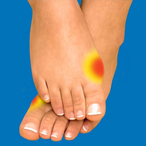 Bunions (Hallux Valgus) Relieve Foot Pain & Leg Pain