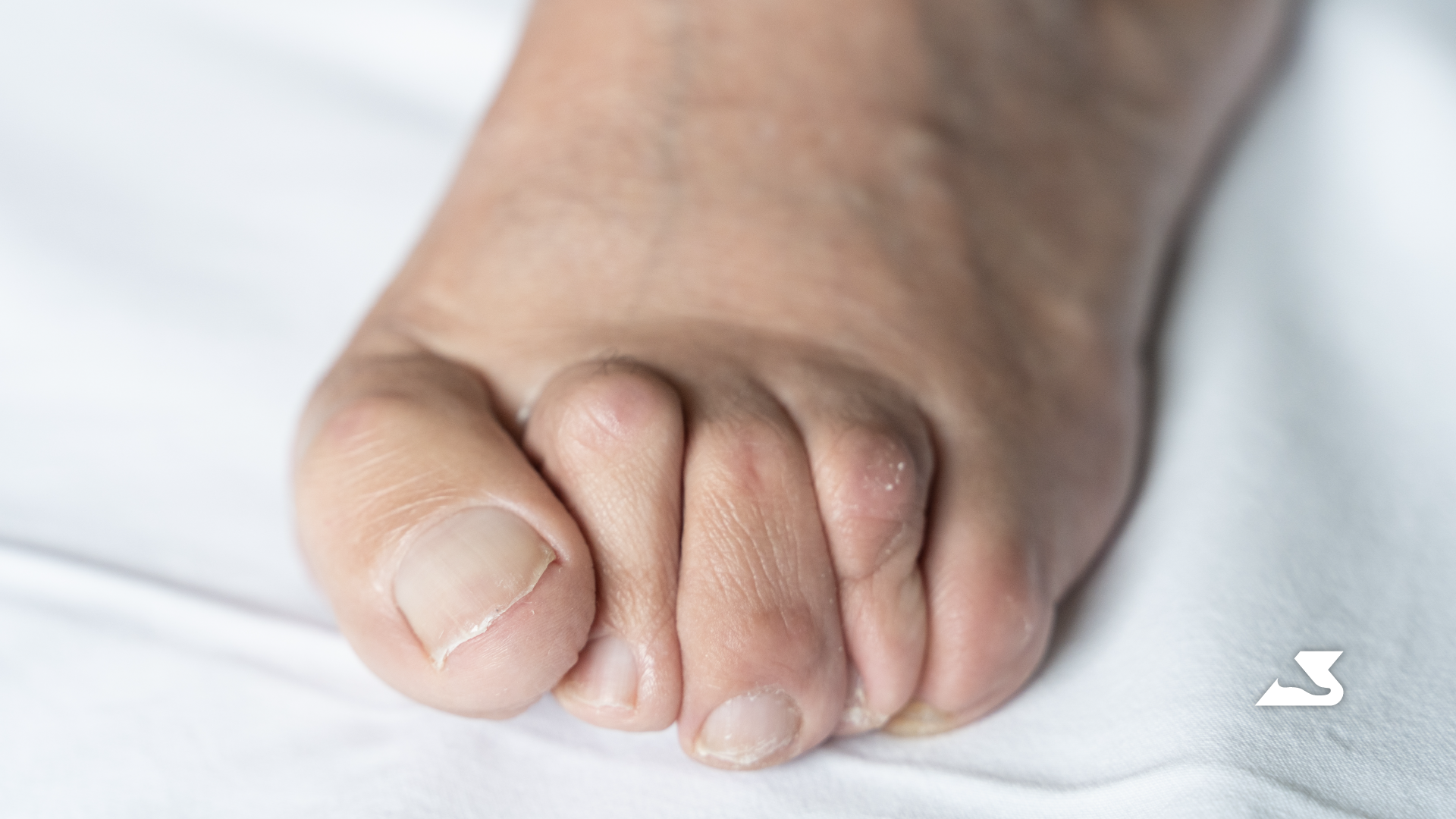 What are Hammertoes?