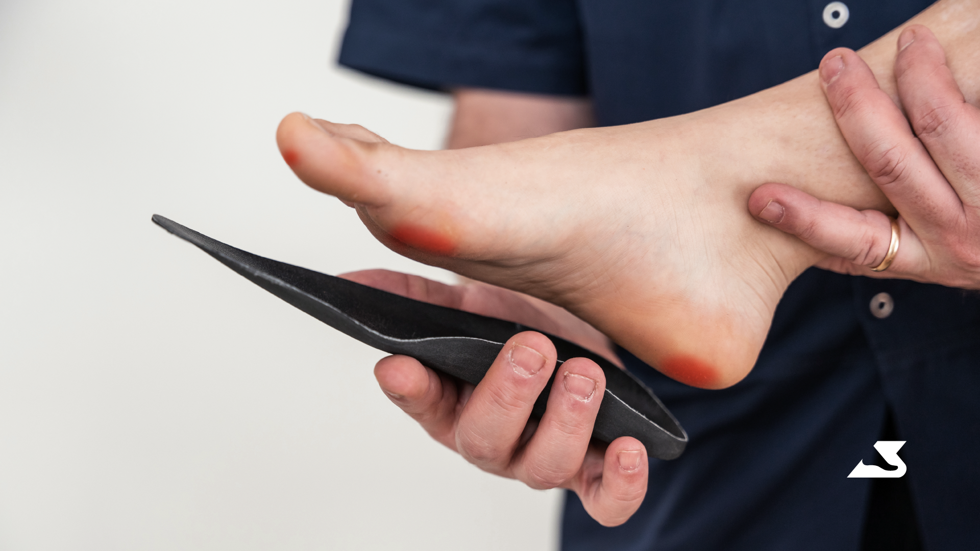 Corns and Calluses: How Orthotics Can Help